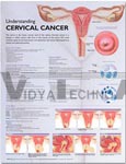 Understanding Cervical Cancer Anatomical Chart